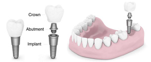 Single tooth replacement implants diagram